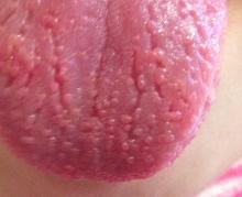 Tongue with prominent papillae